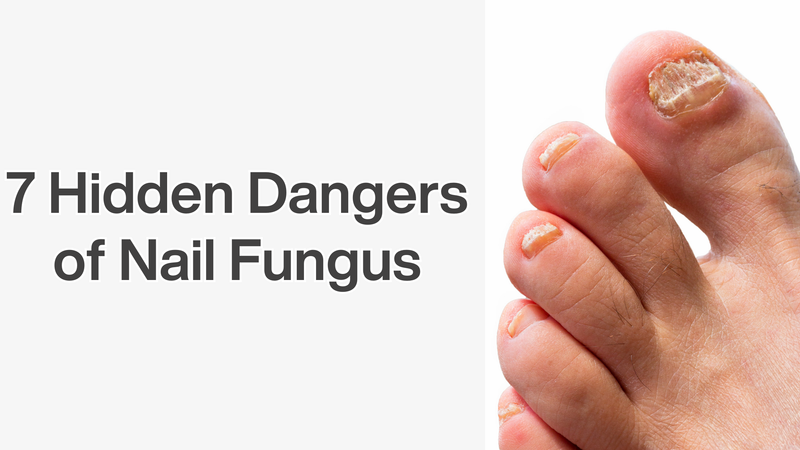 7 Hidden Dangers of Nail Fungus