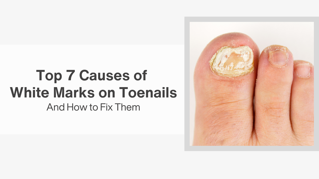 Top 7 Causes of White Marks on Toenails and How to Fix Them